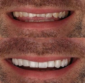 before-after photo smile-makeover