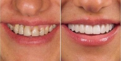 before-after photo smile-makeover