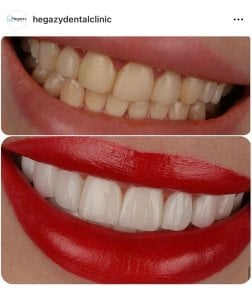 before-after photo smile-makeover