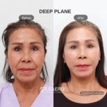 Before and after deep plane facelift results at SAERO Plastic Surgery, facial rejuvenation