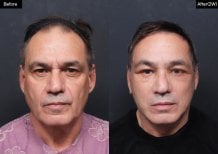 Facelift before and after results at VG Plastic Surgery – visible facial rejuvenation in male patient