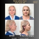 Before and after deep plane facelift and neck lift results at ID Clinic Bangkok, 10 days post-op