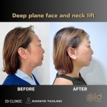 Before and after deep plane facelift and neck lift results at ID Clinic Bangkok