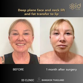 Before and after deep plane facelift and neck lift with lip fat transfer at ID Clinic Bangkok