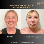 Before and after deep plane facelift and neck lift with lip fat transfer at ID Clinic Bangkok