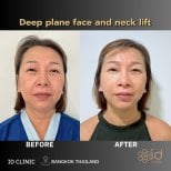 Before and after deep plane facelift and neck lift results at ID Clinic Bangkok