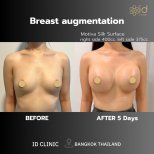 Before and after breast augmentation results at ID Clinic Bangkok, fuller shape after 5 days