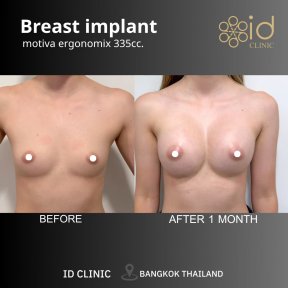 Before and after breast augmentation with Motiva implants at ID Clinic Bangkok, 1 month result