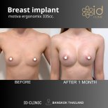 Before and after breast augmentation with Motiva implants at ID Clinic Bangkok, 1 month result