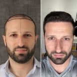 Before and after DHI hair transplant result at Este Favor Hair Transplant Clinic, restored hairline