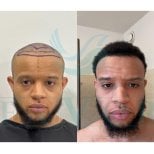 نتائج زراعة الشعر الأفريقي قبل وبعد في عيادة Este Favor، خط شعر أكثر كثافة