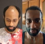 نتائج زراعة الشعر الأفريقي قبل وبعد في عيادة Este Favor، خط شعر أكثر كثافة