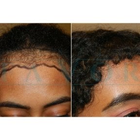نتائج زراعة الشعر الأفريقي قبل وبعد في عيادة Este Favor، خط شعر أكثر كثافة