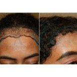 نتائج زراعة الشعر الأفريقي قبل وبعد في عيادة Este Favor، خط شعر أكثر كثافة