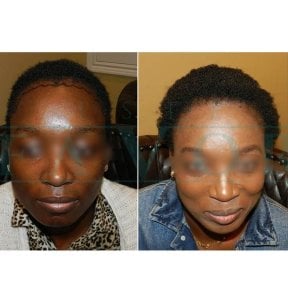 نتائج زراعة الشعر الأفريقي قبل وبعد في عيادة Este Favor، خط شعر أكثر كثافة