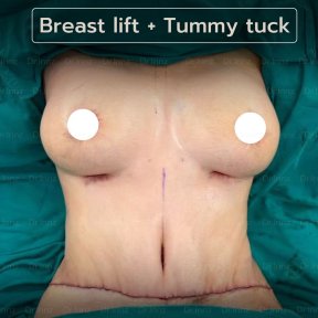 before-after photo arms-plastics-brachioplasty