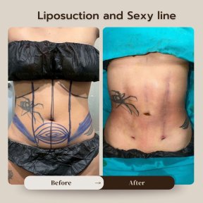 before-after photo arms-plastics-brachioplasty