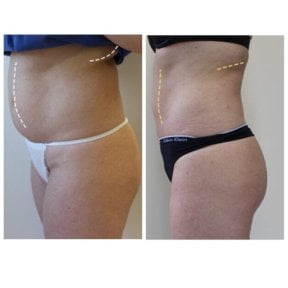 Before and after tummy tuck results at Klinika La Perla – flatter abdomen and body contour