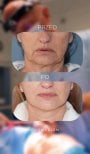 Before and after mini facelift results at Klinika Promedion – visible facial rejuvenation