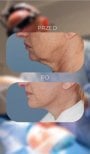 Before and after mini facelift results at Klinika Promedion, visible jawline tightening