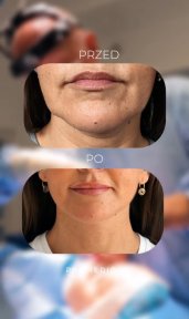 Before and after mini facelift results at Klinika Promedion, visible facial rejuvenation