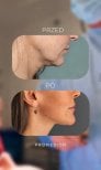 Before and after mini facelift results at Klinika Promedion – improved jawline contour