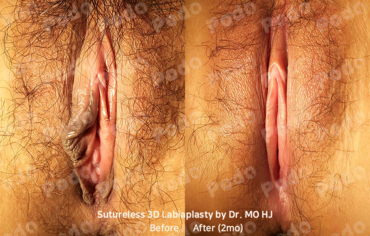 نتائج قبل وبعد تجميل الشفرين مع Dr. MO HJ – تحسين شكل الشفرين بعد شهرين
