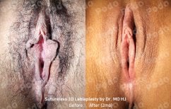 Before and after sutureless 3D labiaplasty results by Dr. MO HJ, visible labia reduction