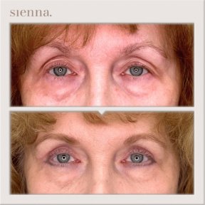 before-after photo tightening-of-facial-skin-facelift