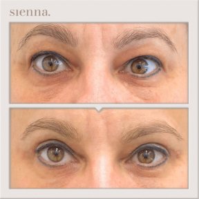 before-after photo tightening-of-facial-skin-facelift