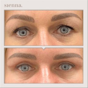 before-after photo tightening-of-facial-skin-facelift