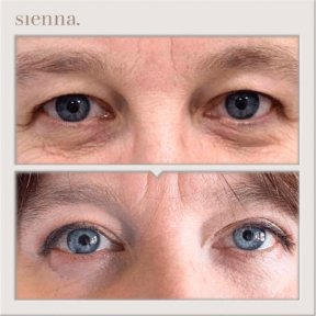 before-after photo tightening-of-facial-skin-facelift