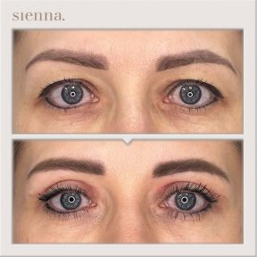 before-after photo tightening-of-facial-skin-facelift