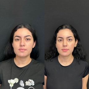 before-after photo rhinoplasty-nose-job