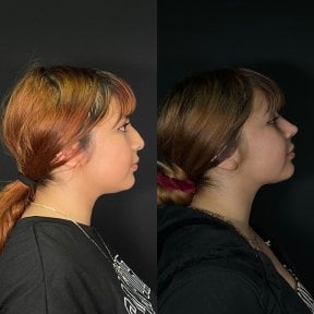 before-after photo rhinoplasty-nose-job