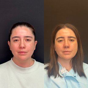 before-after photo rhinoplasty-nose-job