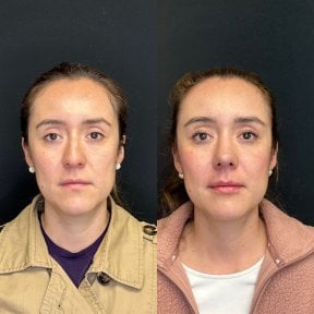 before-after photo rhinoplasty-nose-job