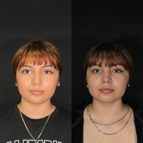 before-after photo rhinoplasty-nose-job