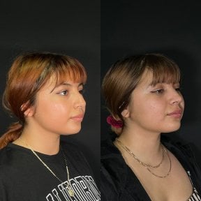 before-after photo rhinoplasty-nose-job