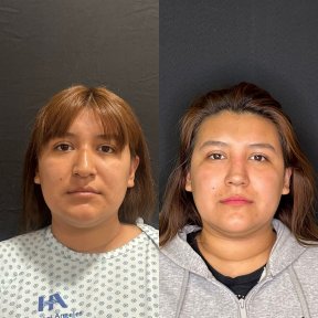 before-after photo rhinoplasty-nose-job