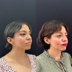 before-after photo rhinoplasty-nose-job