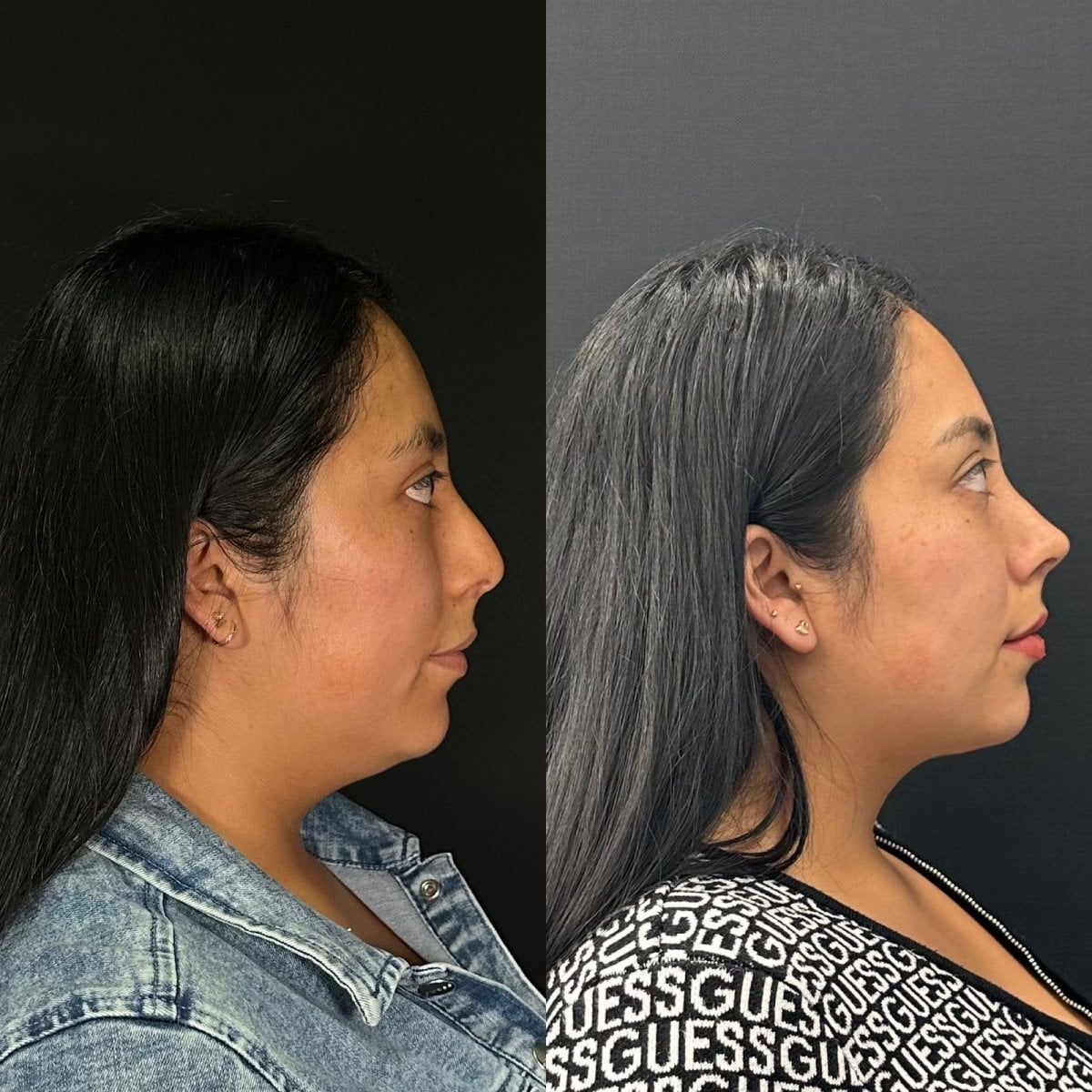 Resultados de rinoplastia antes y después en Zafir Medical Center, perfil nasal mejorado