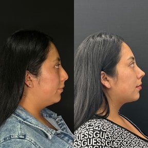 before-after photo rhinoplasty-nose-job