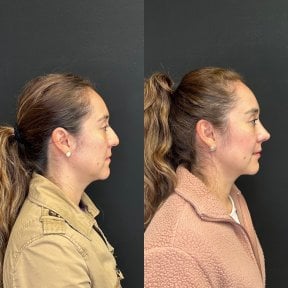 before-after photo rhinoplasty-nose-job