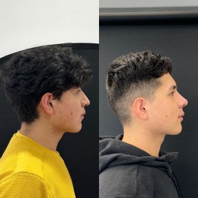 before-after photo rhinoplasty-nose-job