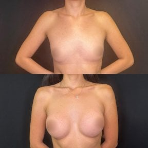before-after photo rhinoplasty-nose-job