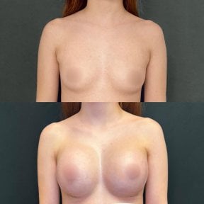 before-after photo rhinoplasty-nose-job