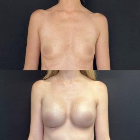 Before and after breast augmentation results at Zafir Medical Center, enhanced breast volume