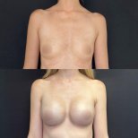 Before and after breast augmentation results at Zafir Medical Center, enhanced breast volume