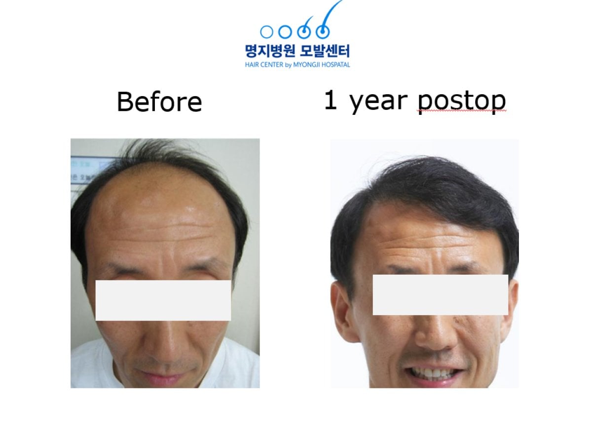 Resultado de trasplante capilar en Myongji Hospital: antes y después, línea más densa tras 1 año